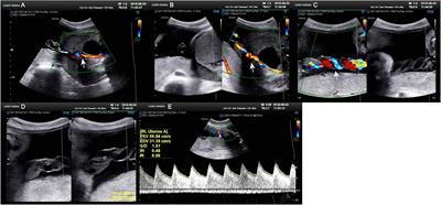 Umbilical artery thrombosis and maternal positive autoimmune antibodies: two case reports and a literature review